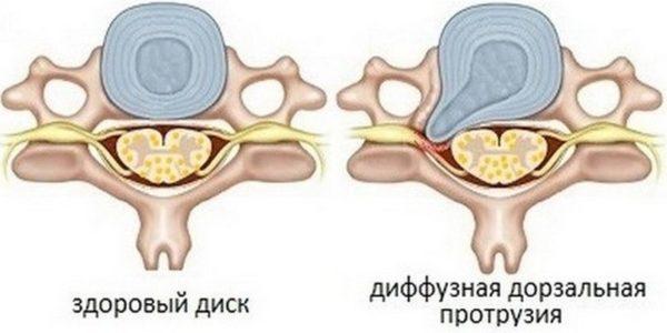 Дорзальная диффузная протрузия