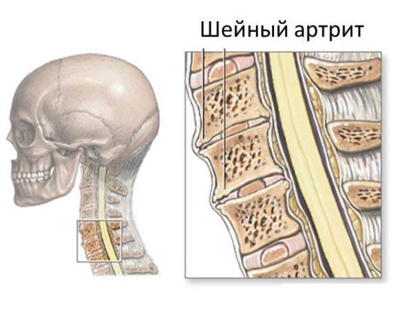 Артрит шейного отдела позвоночника