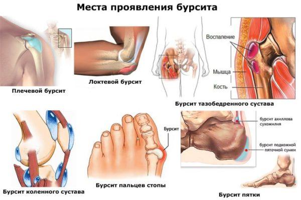 Места проявления бурсита