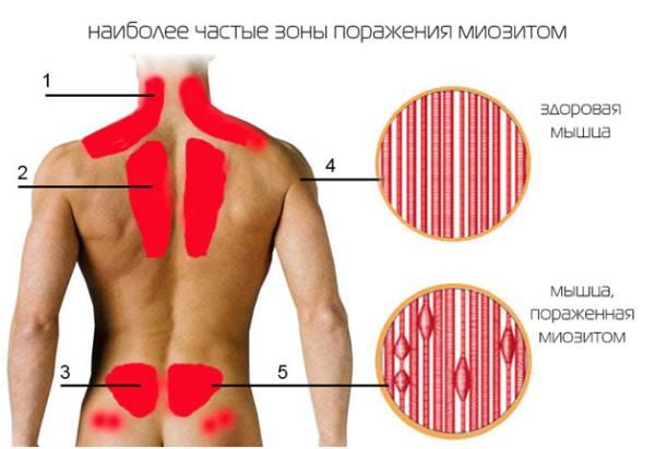 Мышца пораженная миозитом изнутри