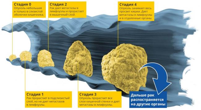 Рак толстой кишки