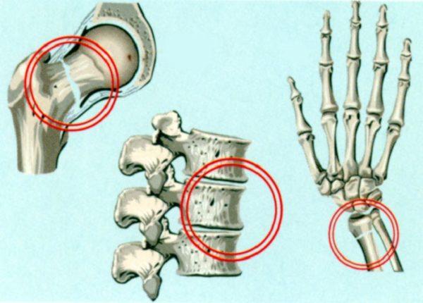 При остеопорозе риск переломов значительно возрастает