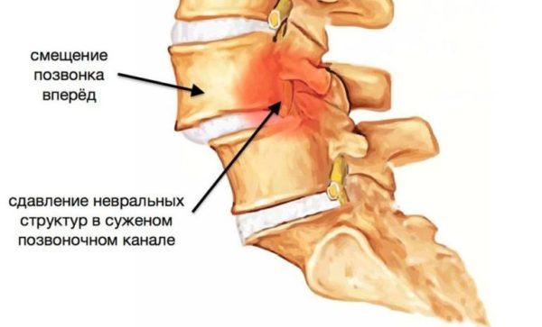 Антелистез позвоночника