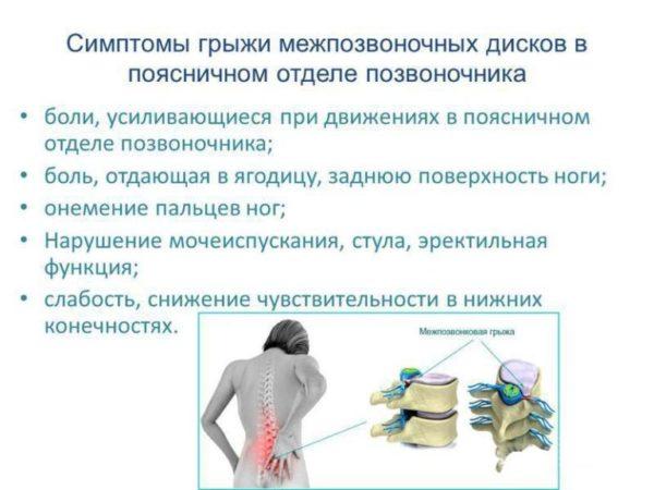 Cимптомы межпозвоночной грыжи поясничного отдела 