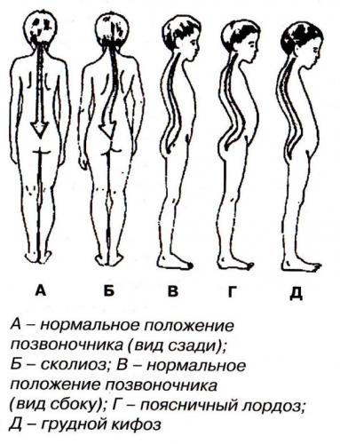 Основные типы нарушения осанки