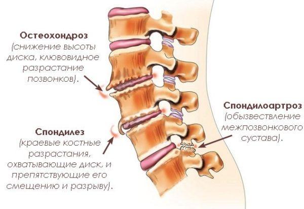 К деформирующей дорсопатии можно отнести ранние стадии остеохондроза, спондилоартроза и спондилеза 