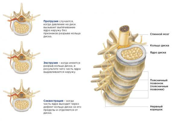 Три типа межпозвоночной грыжи
