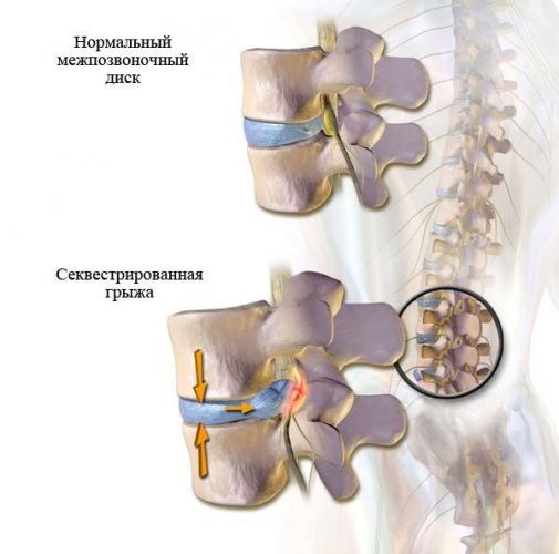 Секвестрированная грыжа позвоночника