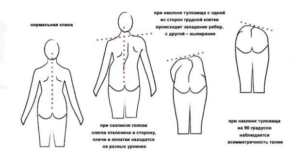 Признаки сколиоза