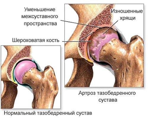 Артроз тазобедренного сустава