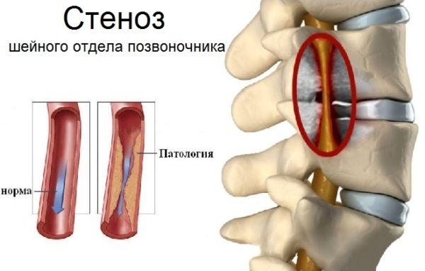 Сужение сосудов шейного отдела позвоночника