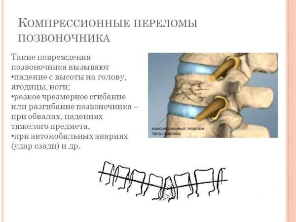 Переломы компрессионного типа