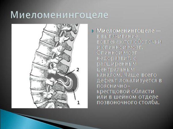 миеломенингоцеле 