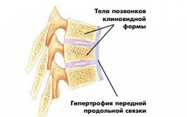 Пораженные позвонки приобретают клиновидную форму, продольная связка утолщается