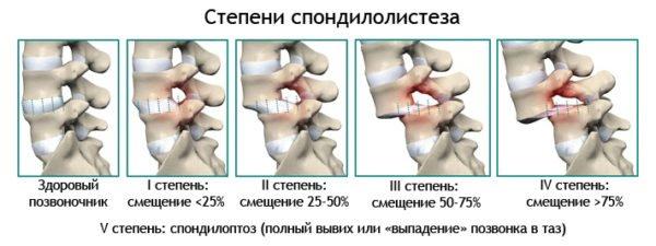 Степени тяжести в зависимости от глубины смещения позвонка