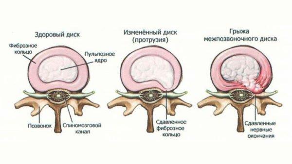 Грыжа диска позвоночника