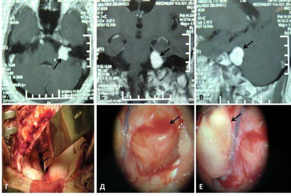 Хирургическое удаление невриомы