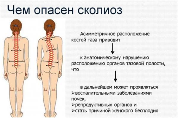 Опасность сколиоза