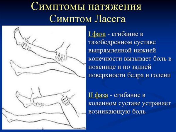 Что такое симптом Ласега 
