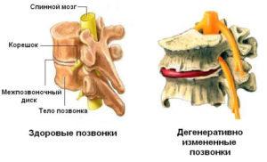 Дегенеративные изменения