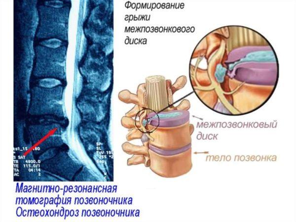 Снимок остеохондроза межпозвоночных дисков