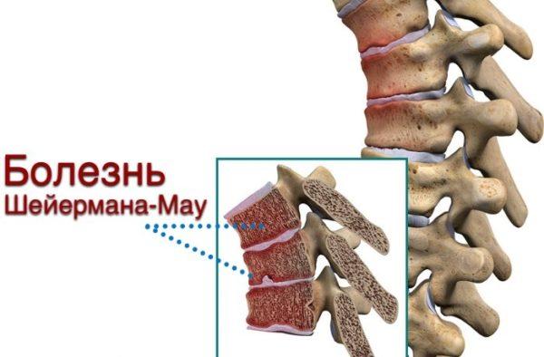 Заболевание характеризуется изменением формы позвонков и наличием вертикальных грыж