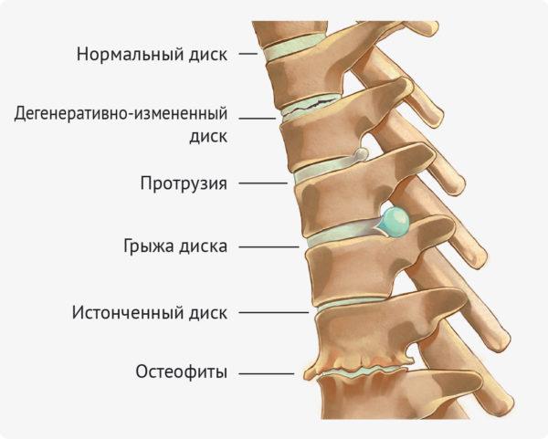 Грыжа межпозвонкового отдела — это смещение части деформированного межпозвоночного диска