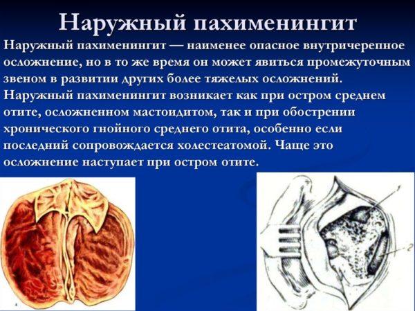 Наружный пахименингит