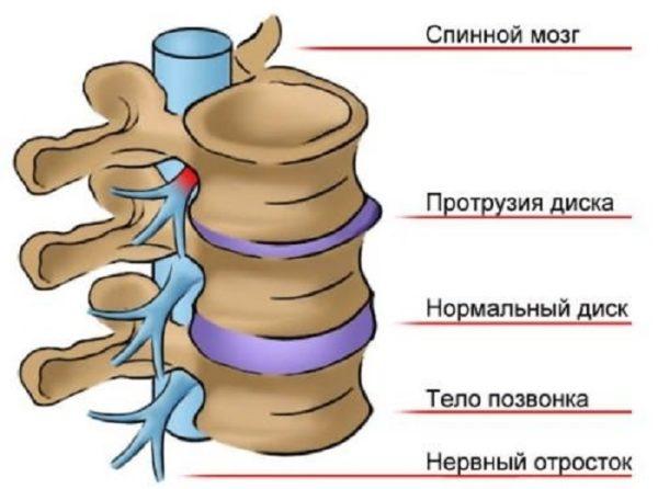 Протрузия межпозвонкового диска