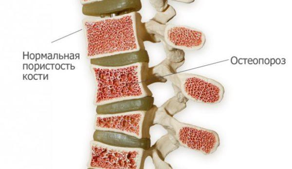 Показанием к назначению денситометрии является остеопороз и родственные ему патологии
