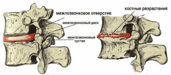 На картинке слева изображен здоровый позвоночный канал, а справа при наличии болезни – спондилеза