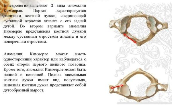 Классификация Аномалии Киммерле