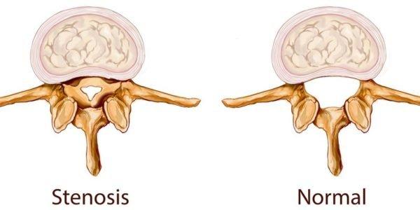 Стеноз позвоночного канала