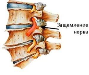 Компрессионный