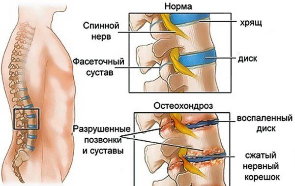 Остеохондроз поясничного отдела