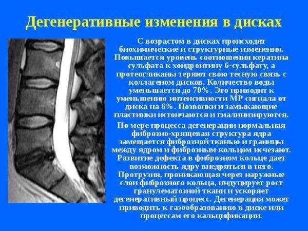 Дегенеративно-дистрофические изменения