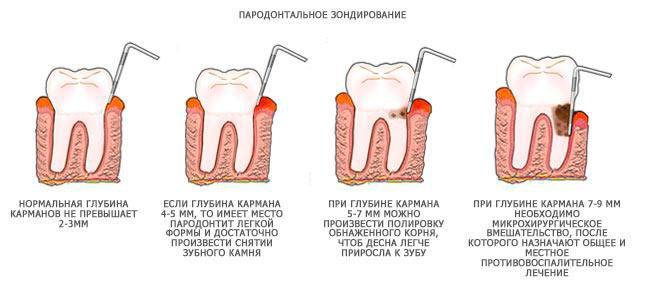 лечение пародонтоза