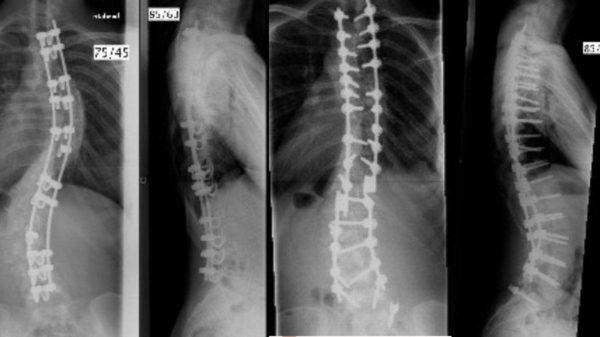 Оперативное лечение сколиоза