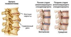 Артрозы и артриты