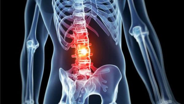 Боль в спине локализуется в зависимости от месторасположения пораженных позвонков