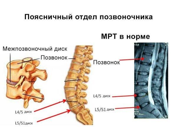 МРТ поясничного отдела здорового позвоночника 