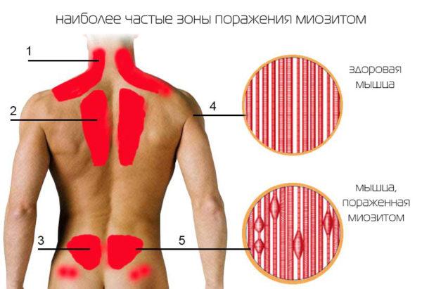 Пораженные мышцы миозитом изнутри