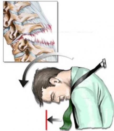 Травма нижнего шейного отдела позвоночника