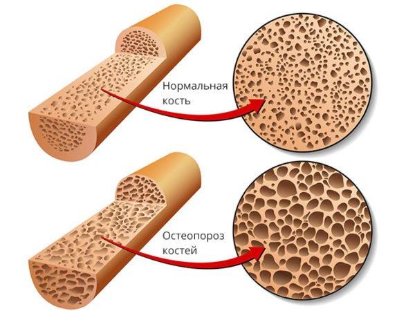 Нормальная костная ткань и при остеопорозе