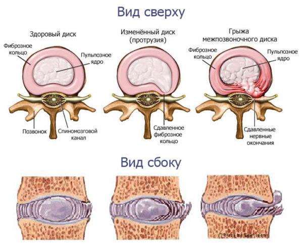 Образование грыжи позвоночника
