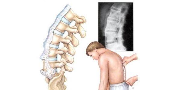 Вылетел диск в позвоночнике