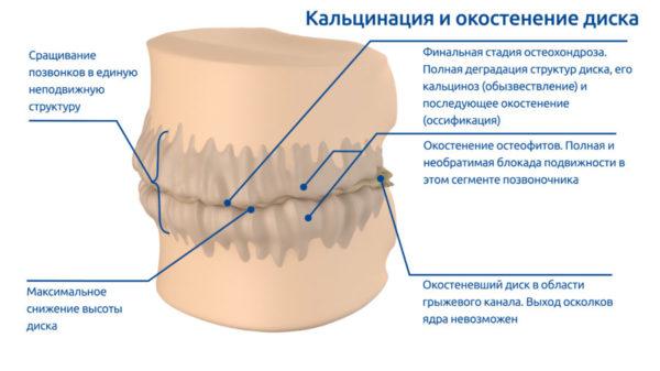 Отложение солей кальция на межпозвоночных дисках может привести к полному обездвиживанию позвоночника