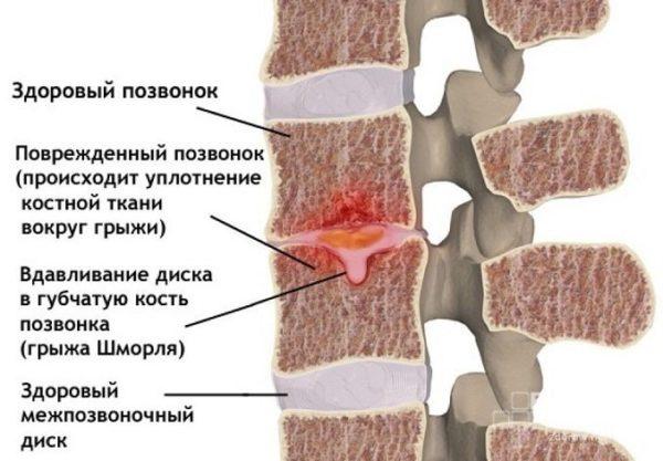 Узелки Шморля позвонков