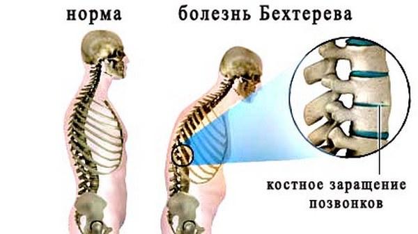 Анкилозирующий спондилоартроз чаще всего развивается у молодых мужчин