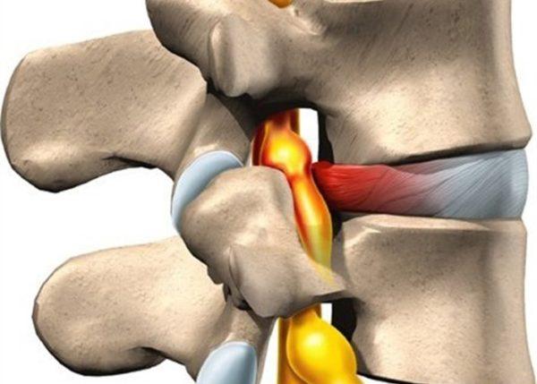 Межпозвоночная грыжа